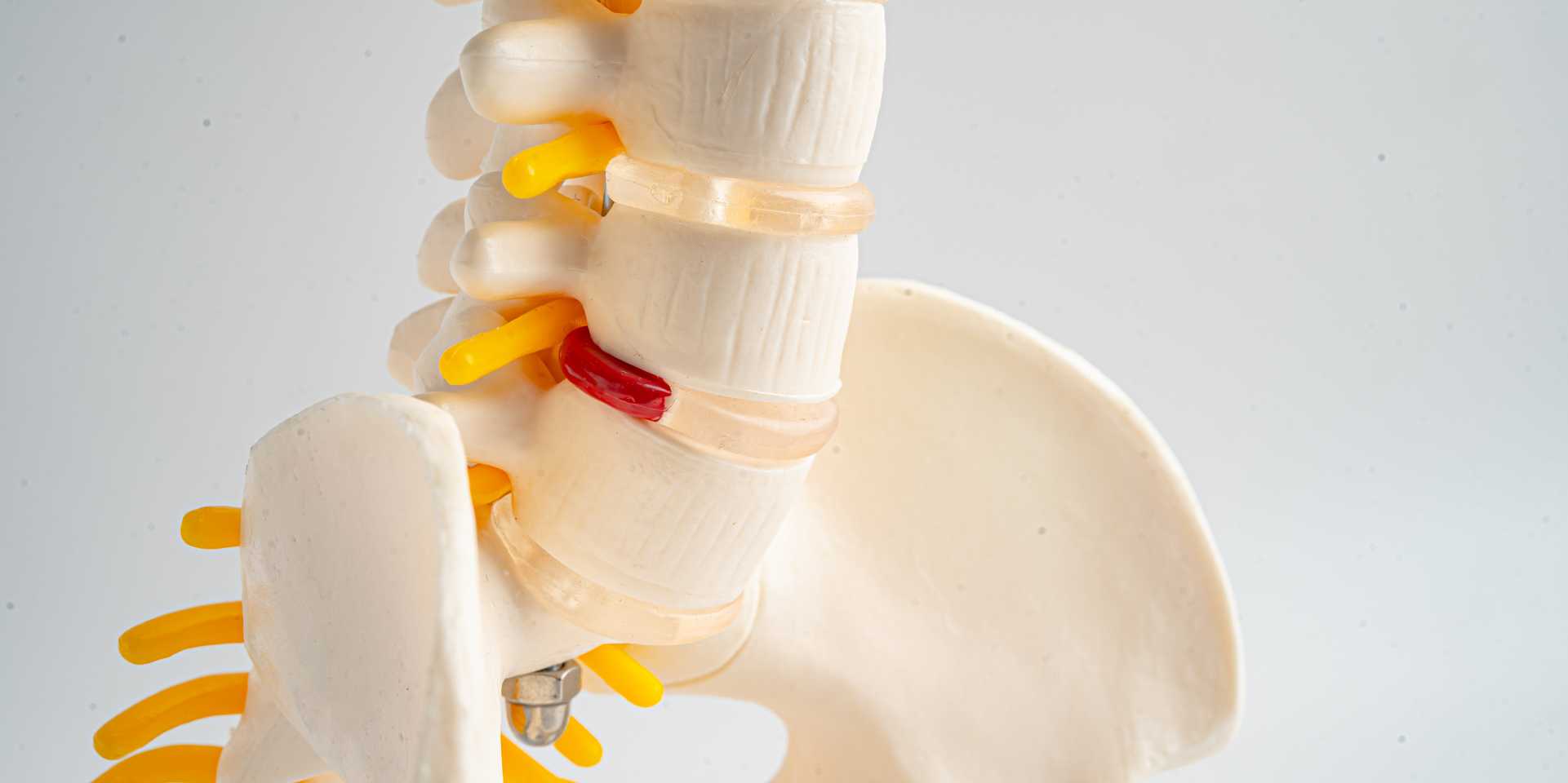 ciática vertebral común tratamiento fisioterapia Barcelona Body Help