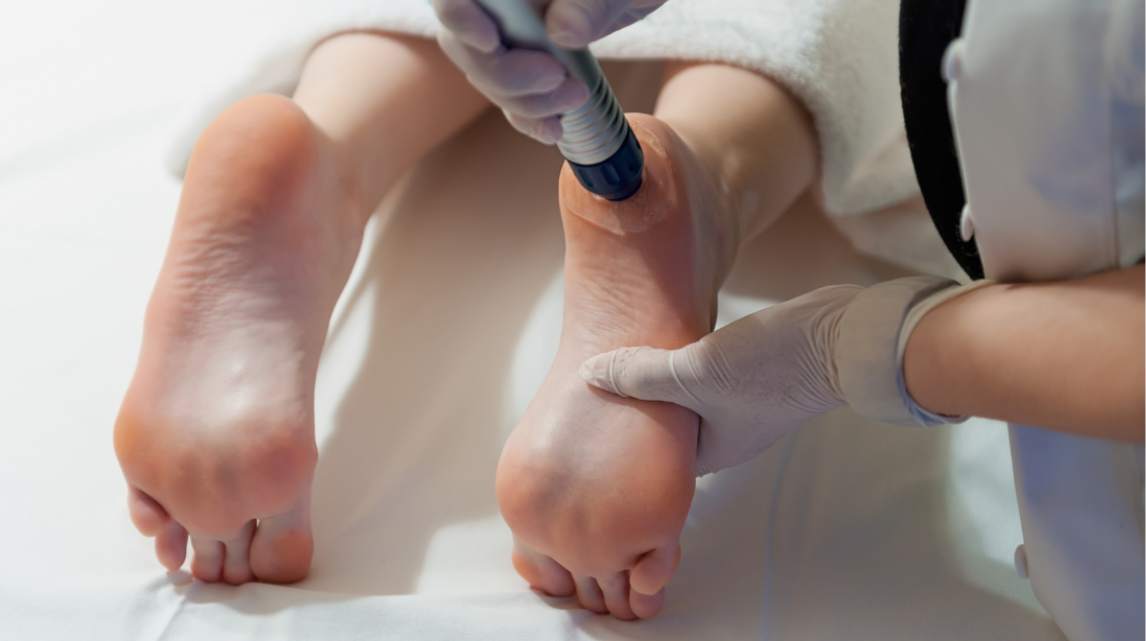 ondas de choque para fascitis plantar en barcelona